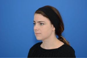 Muốn làm mặt dài hơn thì nên phẫu thuật độn cằm hay tiêm filler cằm?