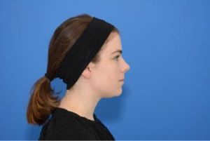 Muốn làm mặt dài hơn thì nên phẫu thuật độn cằm hay tiêm filler cằm?