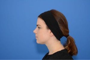 Muốn làm mặt dài hơn thì nên phẫu thuật độn cằm hay tiêm filler cằm?