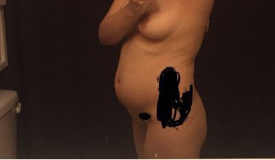 Da lỏng lẻo sau khi hút mỡ có bị vĩnh viễn không? Da lỏng lẻo sau khi hút mỡ có bị vĩnh viễn không?
