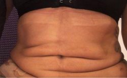 Da lỏng lẻo sau khi hút mỡ có bị vĩnh viễn không?