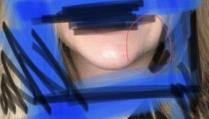 Cằm không cân đối sau khi tiêm filler Voluma, có nên tiêm tan không?