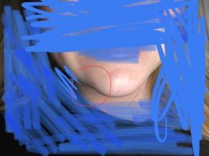 Cằm không cân đối sau khi tiêm filler Voluma, có nên tiêm tan không?