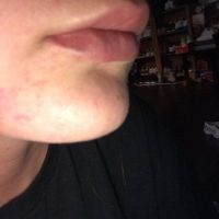 Bao lâu thì môi hết sưng sau khi tiêm filler? Bao lâu thì môi hết sưng sau khi tiêm filler?