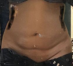 Tôi có nên hút mỡ lần hai không?