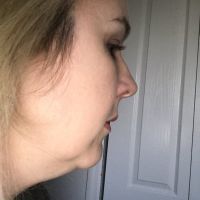 Cách khắc phục cằm bị chảy xệ sau khi tiêm Kybella?