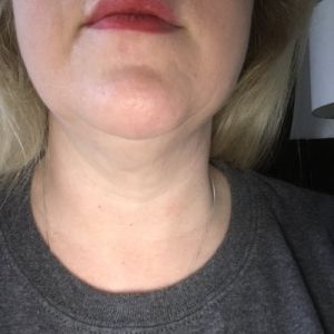 Cách khắc phục cằm bị chảy xệ sau khi tiêm Kybella?