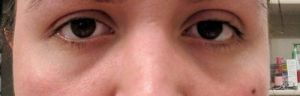 Cần tiêm mấy ống filler vào bên dưới mắt?