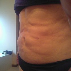 Khắc phục bụng nhăn nheo, lồi lõm sau hút mỡ