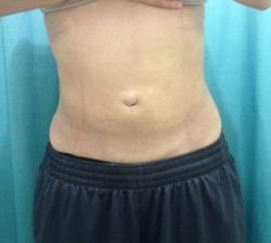 Hai bên không đều sau khi hút mỡ, có cần hút mỡ thêm không?