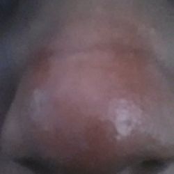 Cách xử lý đường lằn ngang trên mũi