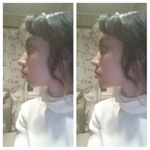 Cằm lẹm thì nên phẫu thuật độn cằm hay tiêm filler cằm?