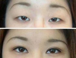 Có thể sửa nếp mí mới lên cao hơn không?