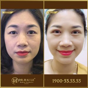 Hình ảnh cắt mí trước sau Dr Hải Lê - Ca 1