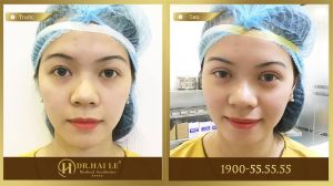 Hình ảnh cắt mí trước sau Dr Hải Lê - Ca 10