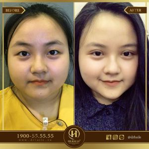 Hình ảnh cắt mí trước sau Dr Hải Lê - Ca 100