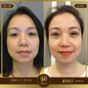 Hình ảnh cắt mí trước sau Dr Hải Lê - Ca 101