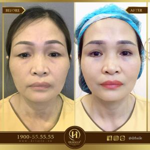 Hình ảnh cắt mí trước sau Dr Hải Lê - Ca 104