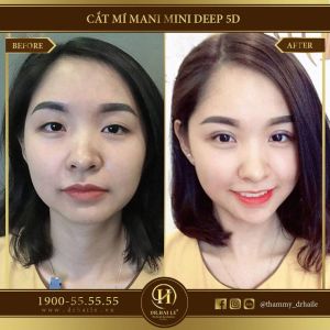 Hình ảnh cắt mí trước sau Dr Hải Lê - Ca 107