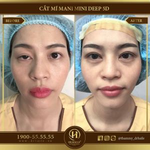 Hình ảnh cắt mí trước sau Dr Hải Lê - Ca 108