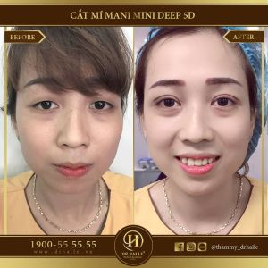 Hình ảnh cắt mí trước sau Dr Hải Lê - Ca 109