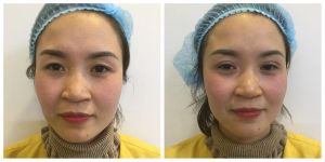Hình ảnh cắt mí trước sau Dr Hải Lê - Ca 11