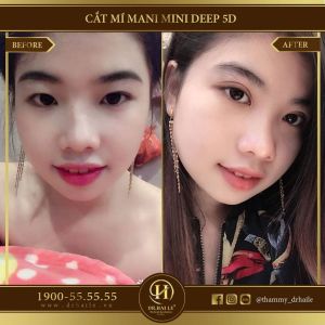 Hình ảnh cắt mí trước sau Dr Hải Lê - Ca 110