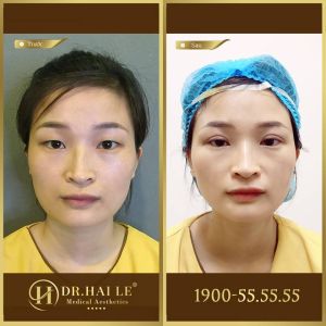 Hình ảnh cắt mí trước sau Dr Hải Lê - Ca 111