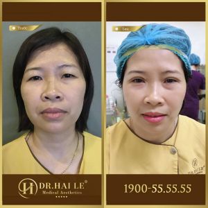 Hình ảnh cắt mí trước sau Dr Hải Lê - Ca 112