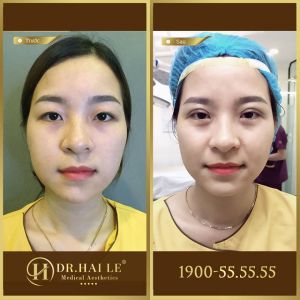 Hình ảnh cắt mí trước sau Dr Hải Lê - Ca 113