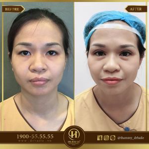 Hình ảnh cắt mí trước sau Dr Hải Lê - Ca 117
