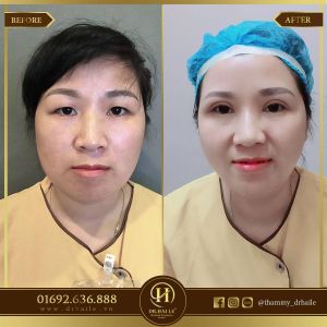 Hình ảnh cắt mí trước sau Dr Hải Lê - Ca 118