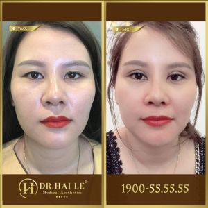 Hình ảnh cắt mí trước sau Dr Hải Lê - Ca 119