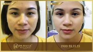 Hình ảnh cắt mí trước sau Dr Hải Lê - Ca 12