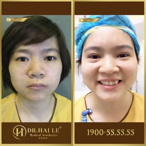 Hình ảnh cắt mí trước sau Dr Hải Lê - Ca 120