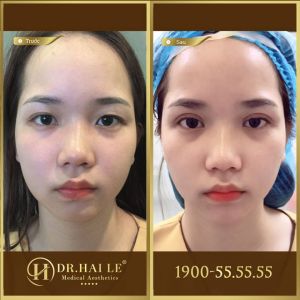 Hình ảnh cắt mí trước sau Dr Hải Lê - Ca 121
