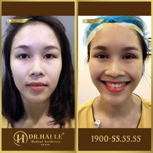 Hình ảnh cắt mí trước sau Dr Hải Lê - Ca 122