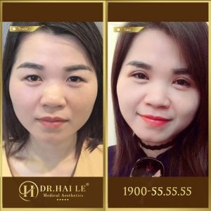 Hình ảnh cắt mí trước sau Dr Hải Lê - Ca 123