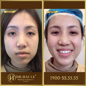 Hình ảnh cắt mí trước sau Dr Hải Lê - Ca 124
