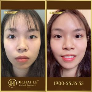 Hình ảnh cắt mí trước sau Dr Hải Lê - Ca 125