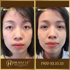 Hình ảnh cắt mí trước sau Dr Hải Lê - Ca 126