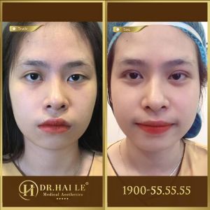 Hình ảnh cắt mí trước sau Dr Hải Lê - Ca 127