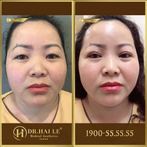 Hình ảnh cắt mí trước sau Dr Hải Lê - Ca 129