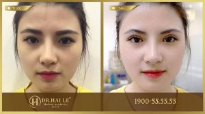Hình ảnh cắt mí trước sau Dr Hải Lê - Ca 13
