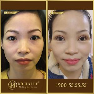 Hình ảnh cắt mí trước sau Dr Hải Lê - Ca 130