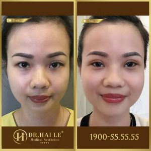 Hình ảnh cắt mí trước sau Dr Hải Lê - Ca 131