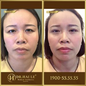 Hình ảnh cắt mí trước sau Dr Hải Lê - Ca 133