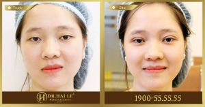 Hình ảnh cắt mí trước sau Dr Hải Lê - Ca 15