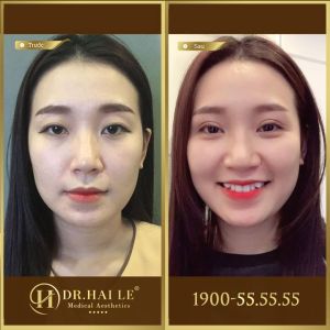 Hình ảnh cắt mí trước sau Dr Hải Lê - Ca 154