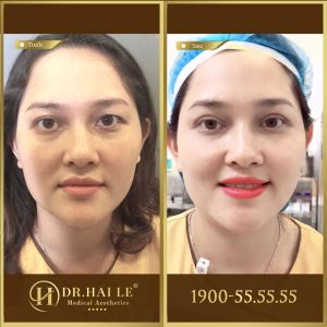 Hình ảnh cắt mí trước sau Dr Hải Lê - Ca 155